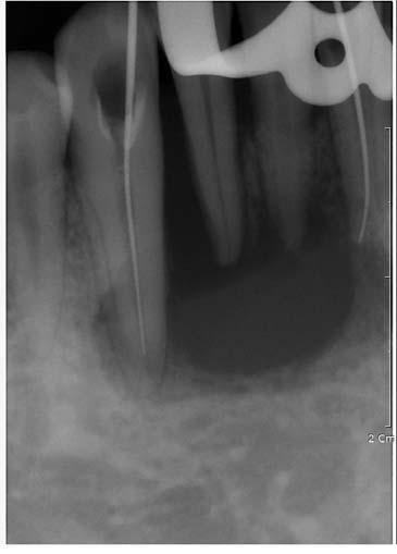 Byung-Do Lee et al Fig. 2. A periapical radiograph shows root canal treatment of the mandibular left central incisor and right canine. Fig. 4.