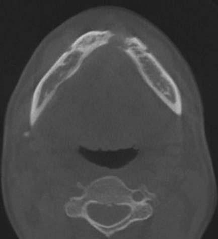 Destruction of the buccal and lingual cortex is also observed. ter with adjacent bone marrow edema (Fig. 4).