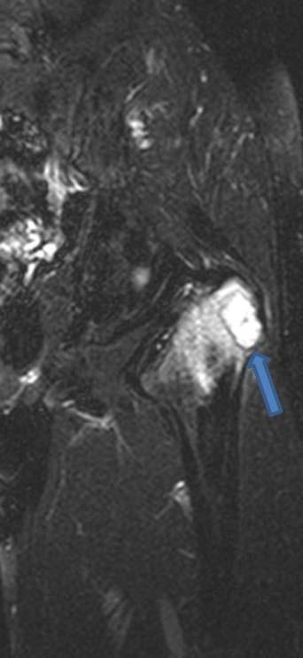 5A); however, a new active bone lesion showing increased radiotracer uptake with a central photopenic finding in the left femur was detected in a one year followup study (Fig. 5B).