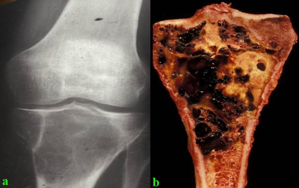 in the medullary cavity of the right humerus. Fig. 5: Figure 5. Giant cell tumor.