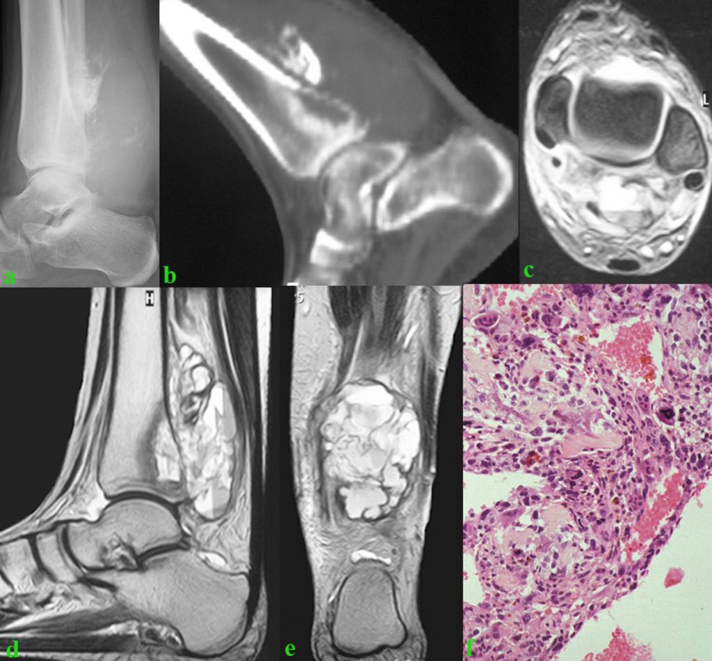 Fig. 8: Figure 7. Telangiectatic osteosarcoma. (a) Lateral plain film and sagittal (b) CT images in a 15-year-old women show a parosteal lytic lesion in the posterior aspect of the tibia.
