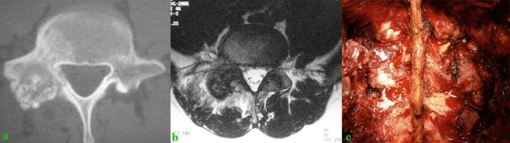 Fig. 9: Figure 8. Osteoblastoma. Axial CT image of a vertebral body shows a expansile and circumscribed lytic lesion with reactive sclerosis and cortical expansion in the right pedicle.