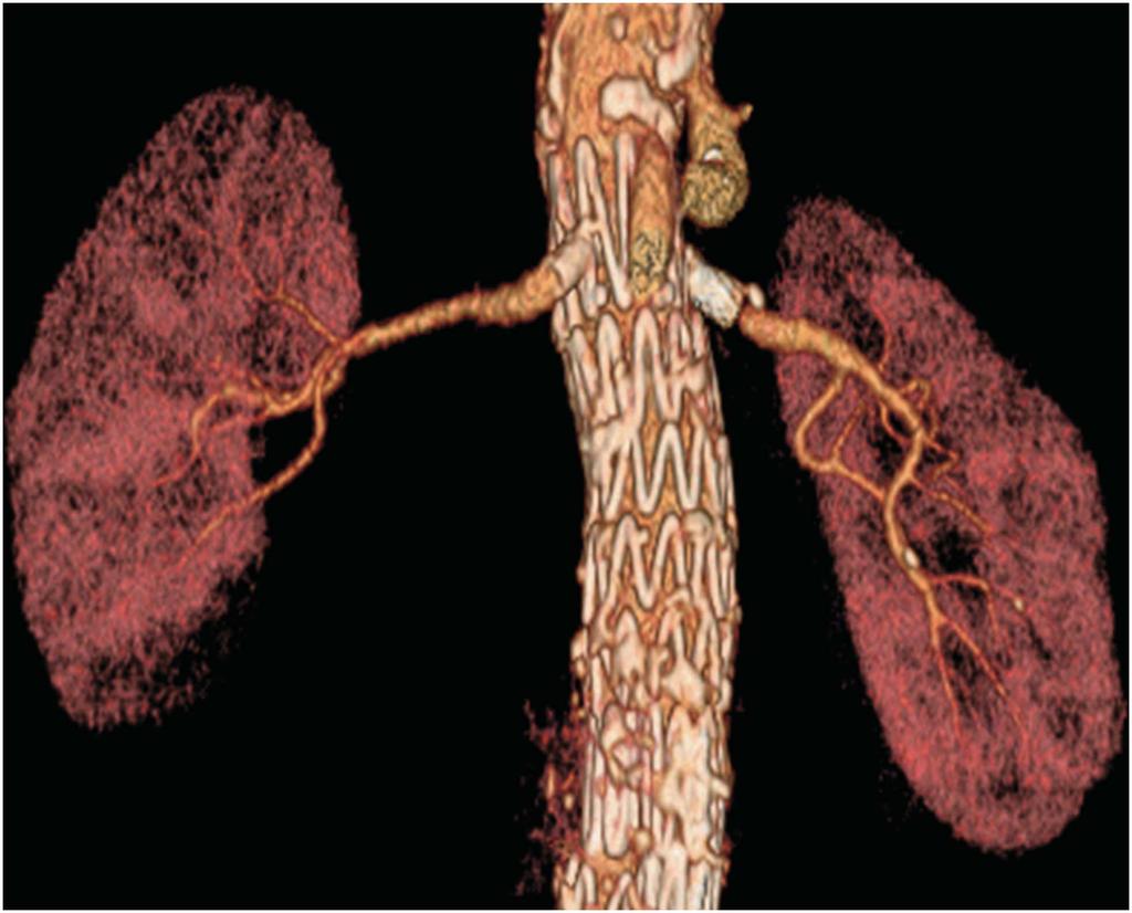 Renal artery stents are placed through the graft struts to maintain renal artery patency, although some deterioration of kidney function and/or embolic injury can occur.