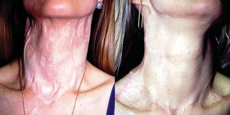 scars of the shoulders. Figure 10. A case of total neck resurfacing of a particularly long neck with two shoulder expanded transposition flaps.