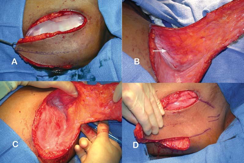 SPENCE Figure 6. (A) The lateral 60% of the flap is raised off the tissue expander. (B) The vessels in the medial base of the expanded skin just deep to the capsule are observed.