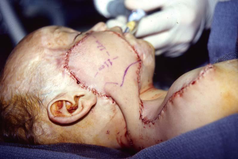 JOURNAL OF BURNS AND WOUNDS VOLUME 6 Figure 7. The flap is inset and the donor site is closed. The tubed pedicle is closed in a spiral fashion so that very little open wound is left.