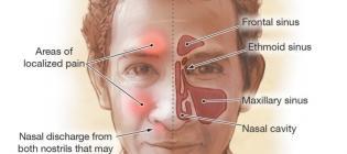 Nasal congestion and obstruction Purulent nasal discharge Maxillary tooth discomfort Facial pain or pressure