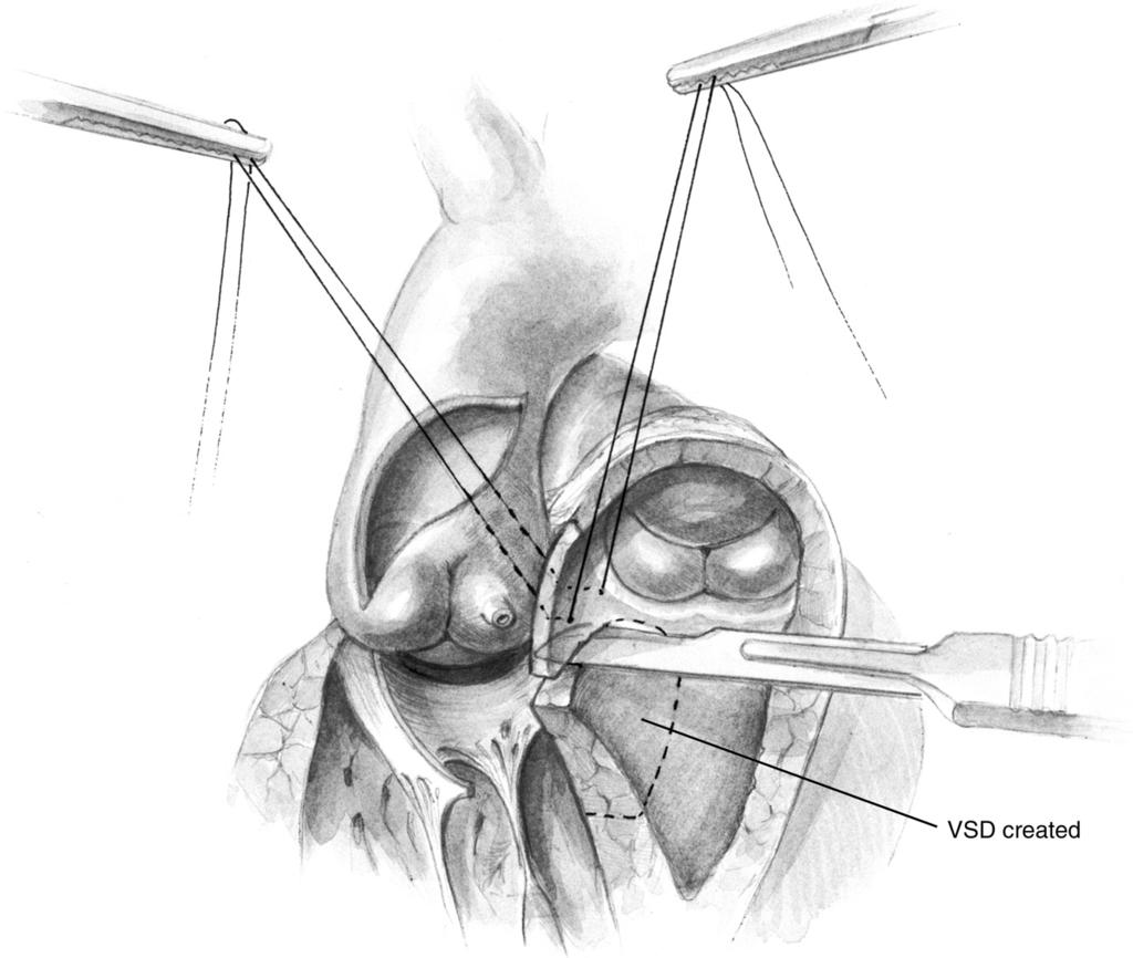 Modified Konno procedure for left ventricular outflow tract obstruction 65 Figure 3 A VSD is created from the right-sided exposure, guided in its extent by the 4-0 polypropylene delimiting sutures.