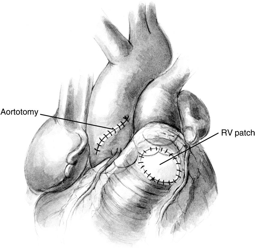 68 D.P. Bichell Figure 6 During rewarming, a patch is used to repair the right ventriculotomy; its configuration is tailored to assure that there is no right ventricular outflow tract restriction.