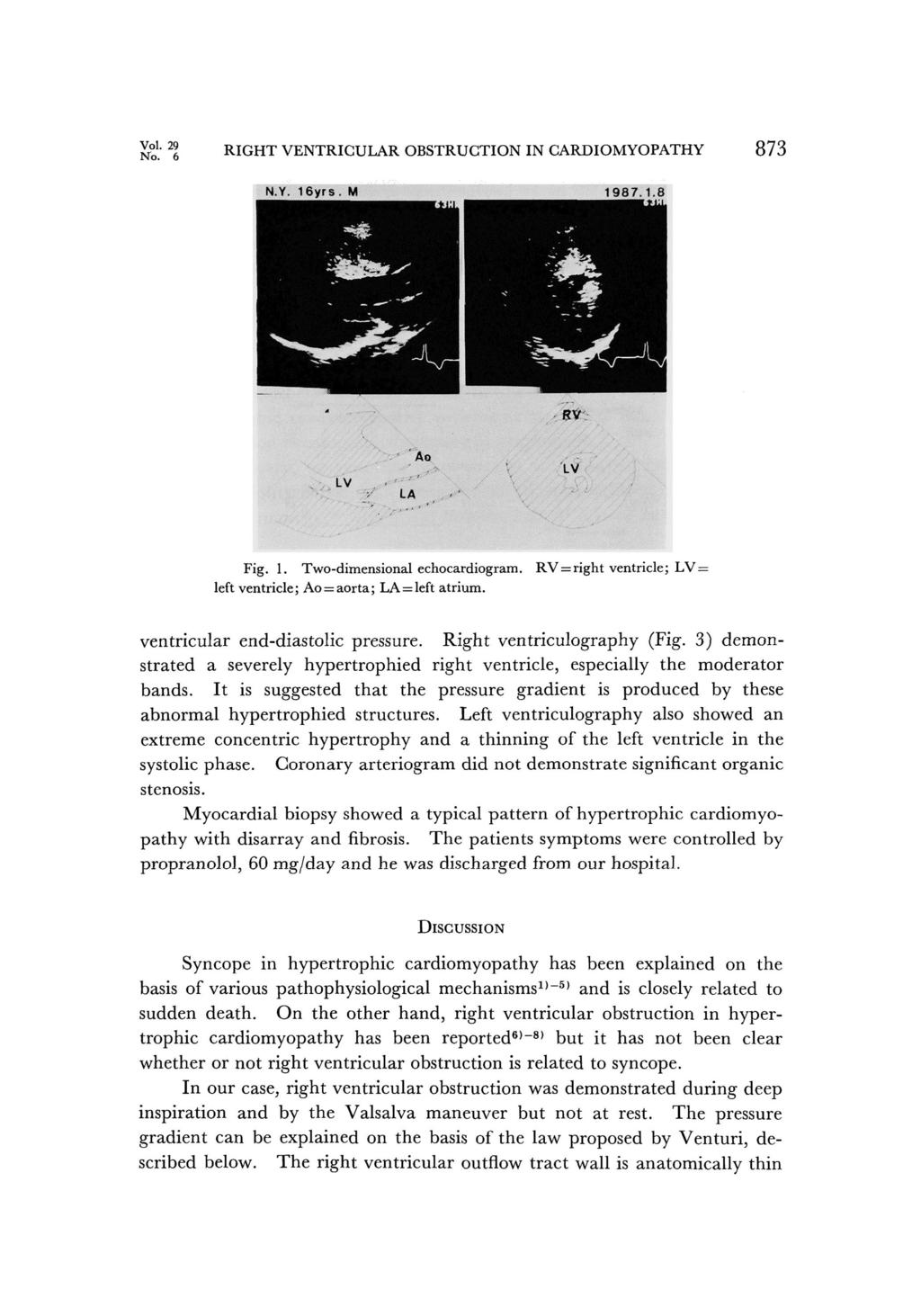 Vol.29 No.6 RIGHT VENTRICULAR OBSTRUCTION IN CARDIOMYOPATHY 873 Fig.1. Two-dimensional echocardiogram. RV=right ventricle; LV= left ventricle; Ao =aorta; LA=left atrium.