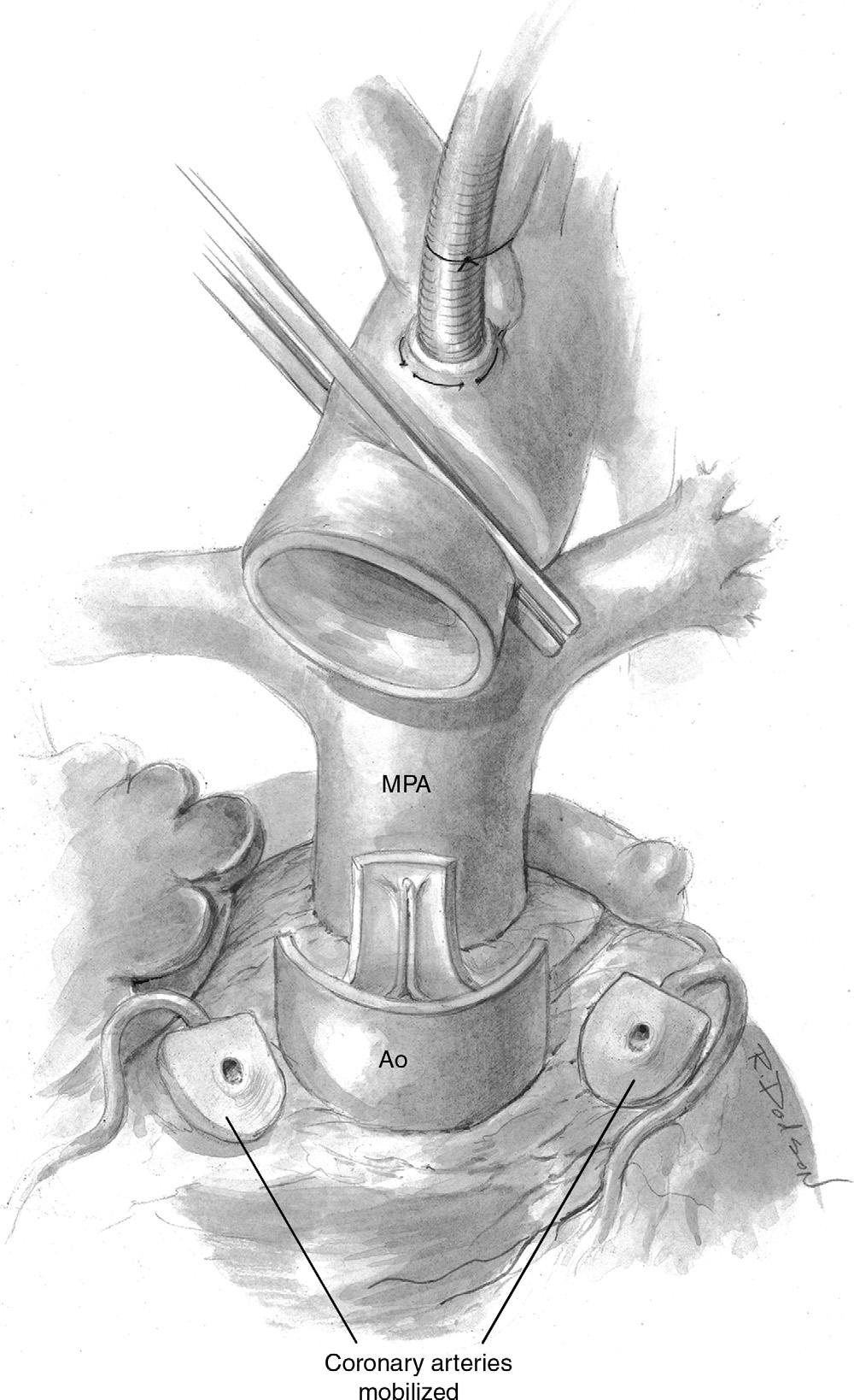 46 R. Mair Operative Technique Figure 1 The aorta is cross-clamped. Cardioplegia is administered; the right atrium is opened, and the patent foramen ovale is closed.
