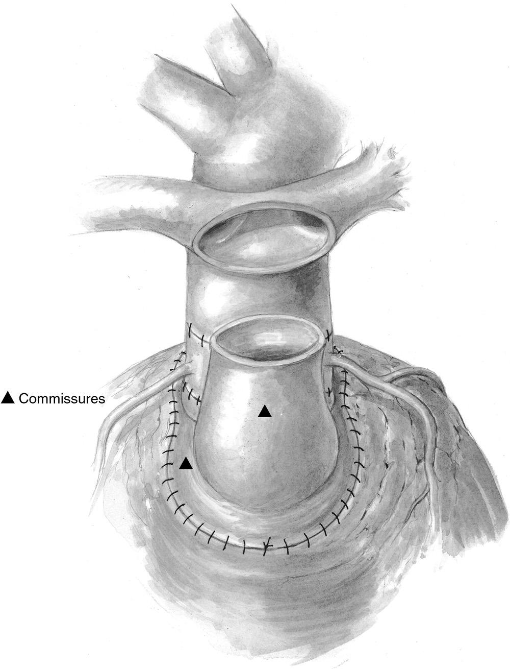 52 R. Mair Figure 7 The pulmonary valve is now inspected and sized. In many cases, it is bicuspid, and in other cases, it is tricuspid and dysplastic.