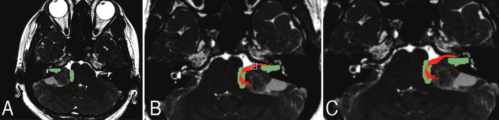 Study of facial nerve reconstruction Fig. 1. FN visualization in a patient with the acoustic neuroma on the right side. A: The green translucent parts show 2 ROIs masks (IAC and FN REZ).