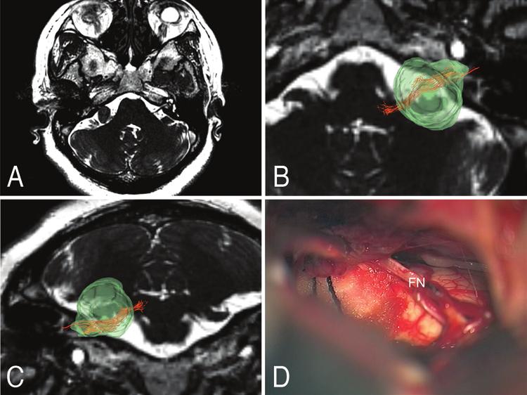 F. Song et al. Fig. 4. Reconstruction of the FN and intraoperative observations of a patient with acoustic neuroma on the right side.