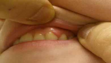 Discussion Pyogenic granuloma is a common benign lesion consisting of exuberant granulation tissue, presenting intraorally usually as a reddened solitary soft swelling on gingiva.