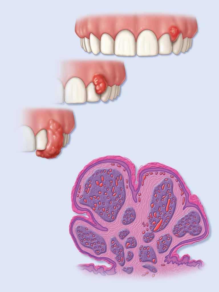 Pyogenic Granuloma of the Gingiva Gross Appearance of Pyogenic Granuloma Lesions Mild Moderate Severe Histological Appearance Lobular