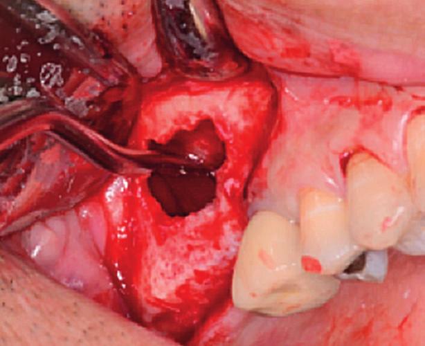 Clinical Cases Sinus floor elevation with Symbios Xenograft Granules,