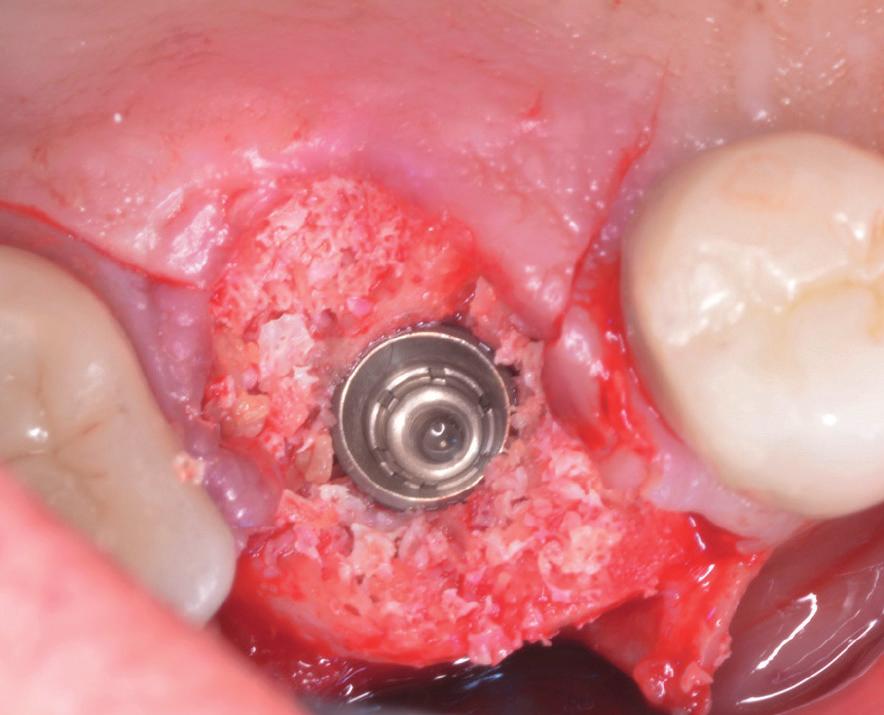 obturated with a composite, particulate graft composed of equal parts Freeze
