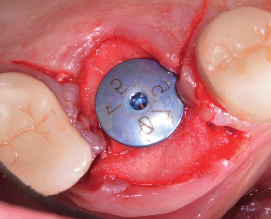 8 mm) is trimmed and adapted via a tissue punch over the healing abutment