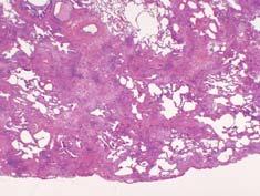 pleuritis, few fibroblast foci (Serologic findings) Familial pulmonary fibrosis (Family history) Drug reactions (Drug history) Miscellaneous rare