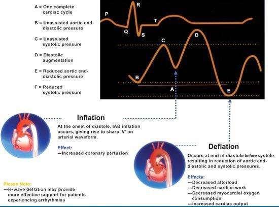 Inflation/Deflation Timing and the Cardiac Cycle Medical Illustration 2002 Arrow International, Inc., http://www.