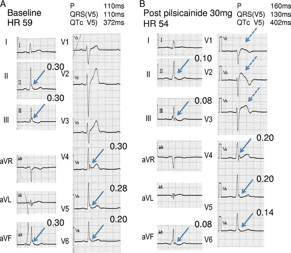 82 Heart Rhythm, Vol 9, No 1, January 2012 Figure 3 Twelve-lead ECGs in a patient with Brugada syndrome under baseline conditions (A) and after pilsicainide administration (B).