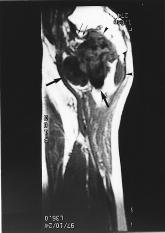 11 1a 1b Figure 1. Osteosarcoma of the proximal femur of a 25-year-old woman. a. Axial T1 weighted imaging (458/17/2) (repetition time/echo time /excitations) and b.