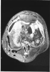 Sagittal T1 weighted imaging (500/10/2) and T2 weighted imaging (3100/91/2) with fat saturation shows low signal on T1 weighted imaging and heterogeneous signal of a tumor