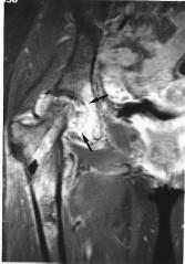 posterior intercondylar space abutting the cruciate ligaments (arrows), with thickening of the wall of the synovium with contrast enhancement (arrowheads).