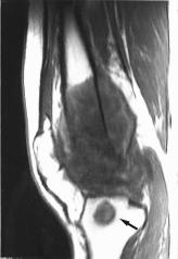 Coronal T1 weighted imaging (738/12/2) with contrast enhancement shows peripheral contrast enhancement of the tumor mass and the skip lesion (arrow) near the joint.