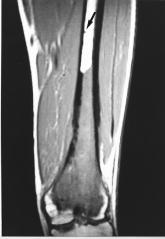 13 5a 5b Figure 5. A 17- year-old boy with osteosarcoma of the distal femur. a.