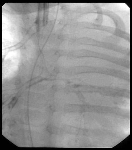 Involvement of the bronchi 4. Presence or absence of complete tracheal rings Short segments of tracheal stenosis may be resected or balloon dilated.