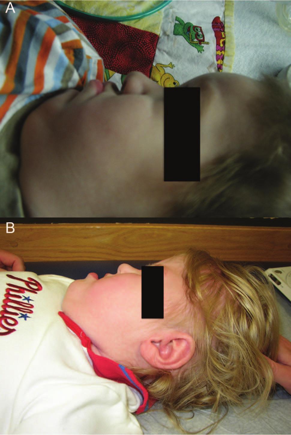 Fig. 5. Alteration in the shape of the face of a boy with myotubular myopathy (A) and a girl with congenital myasthenia gravis (B).