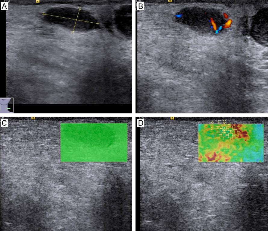 Figure 1. VTIQ graph of malignant lymph nodes. A. Lymph node gray-scale ultrasound showed solid and hypo-echo lymph nodes; B. Color ultrasonography, type IV according to Wu Classification; C.