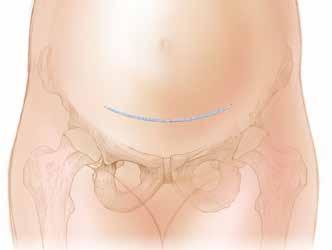 C-Section Delivery of the fetus through an abdominal incision and hysterotomy A surgical incision through the