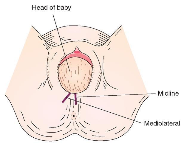 muscles which can cause fecal incontinence Mediolateral Incision begins in the middle of the vaginal opening and extends down toward the buttocks at a 45 O angle Advantage: reduced risk for anal