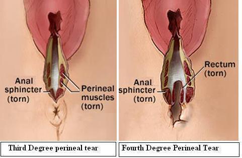 OBJECTIVE 7 - DEFINE DIFFERENT DEG REES OF PERINEAL TEARS, AND THEIR POTENTIAL COMPLICATI ONS 1st degree Injury to perineal skin and vaginal mucosa only
