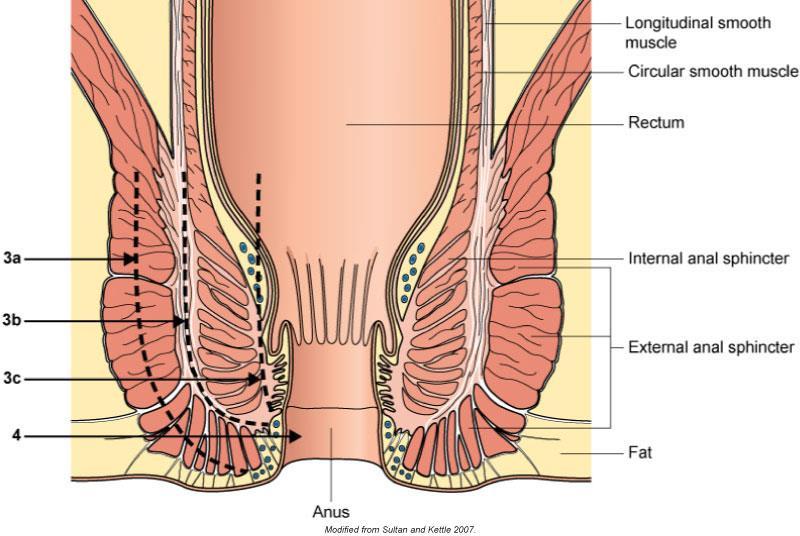 Complications: 3rd degree Injury to perineum involving the anal sphincter complex 3A: Less than 50% of external anal sphincter (EAS) thickness torn 3B: