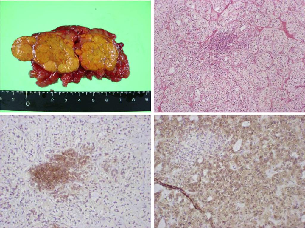 Figure 3. Histological findings of the resected adrenal gland. A, Macroscopic view. B, Hematoxylin and Eosin staining. The adrenal nodules were composed of compact cells and clear cells.