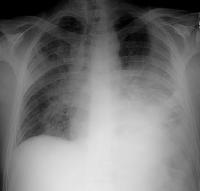 Etiology Chest trauma Surgery TB Malignancy Pneumonia 70% of all empyemas Bacterial pneumonias Up to 40% -