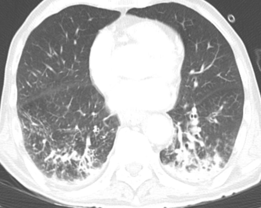 Aspiration pneumonia Imaging findings: Bronchopneumonia pattern Segmental or lobar airspace