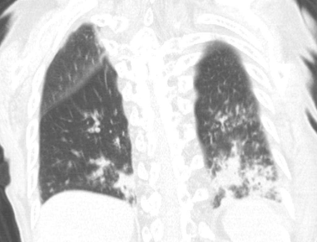 Early chest CT can
