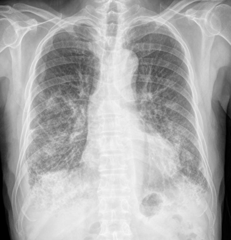 Pulmonary edema vs/and Pneumonia