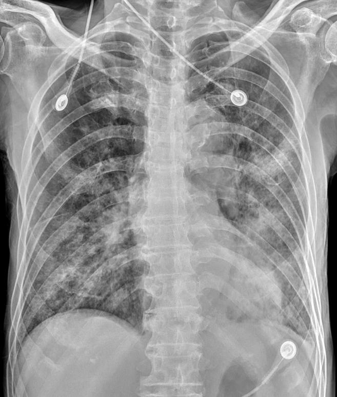 Cardiomegaly Pleural effusion 82/M