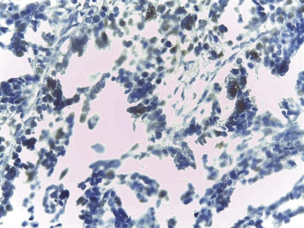 The immunohistochemical expression of p53 and Ki67 in ovarian epithelial borderline tumors P53 immunoexpression For the entire study group, p53-immunoreactions became positive in 10 cases, all serous