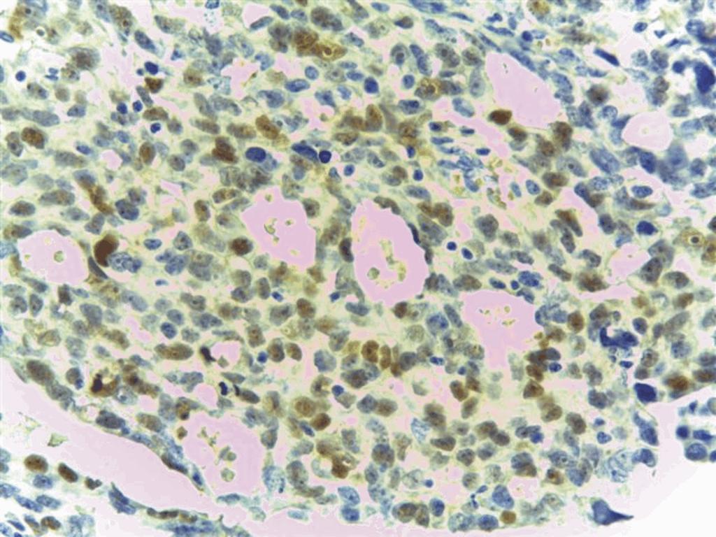 Nuclear staining was in general intense and moderate and was limited only to neoplastic cells, without interesting the stromal nuclei.