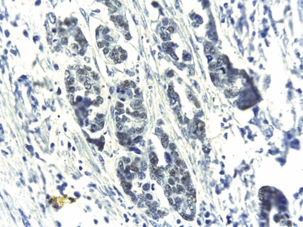 Luminiţa Nicoleta Giurgea et al. 970 cells of 75% (score 3) in 41.