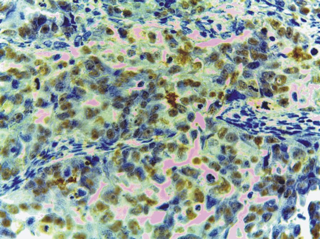 heterogeneous pattern, ob. 20. We identified two cases of stage II low-grade carcinomas Ki67 positive immunoreactions and two cases stage III low-grade carcinomas, corresponding with 66.
