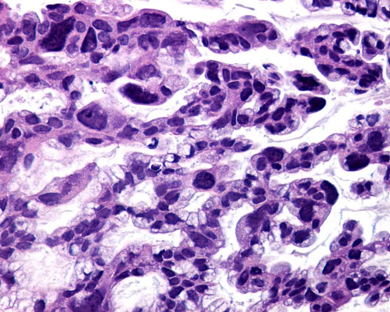Ovary, Papillary Tumor with Unusual Features (Intracellular Mucin,