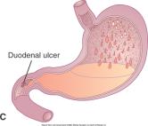 Peptic Ulcer Disease (PUD) 1. Gastric Ulcers: anywhere in stomach but normally along lesser curvature of stomach Low acid secretion 2.